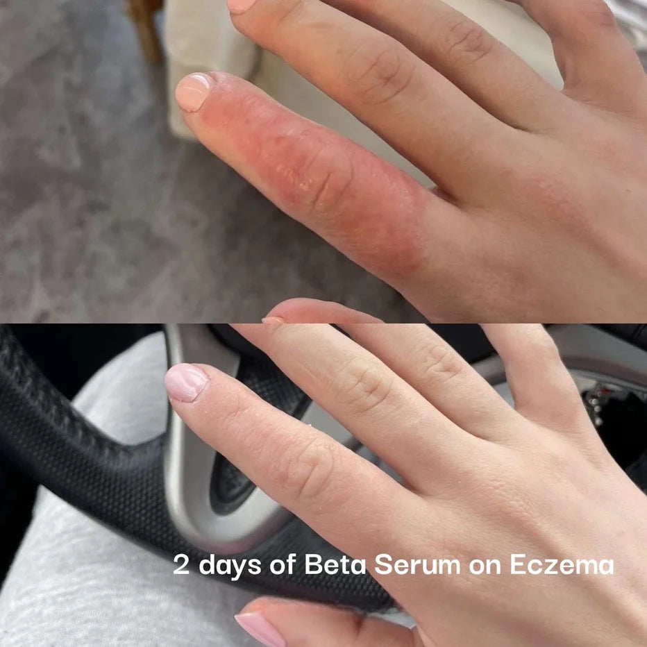 Beta-Glucan Skin Recovery Serum (1 x 15ml & 1 x Sheet Mask) TRY ME