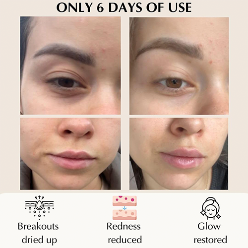 3D Laser High-Efficiency Skin Rejuvenation Mask